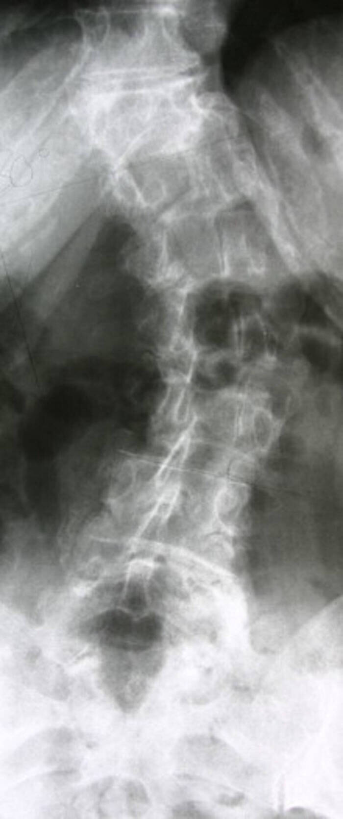 Degenerative Skoliose