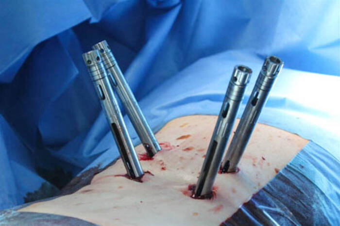 Minimalinvasive Wirbelsäulenstabilisierung