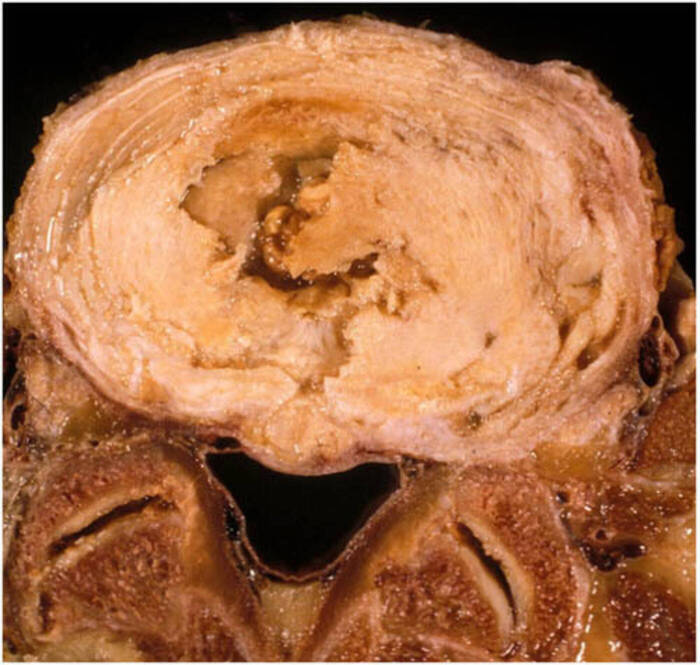 Anatomisches Präparat eines Bandscheibenvorfalls