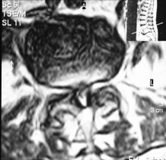Spinalkanalstenose